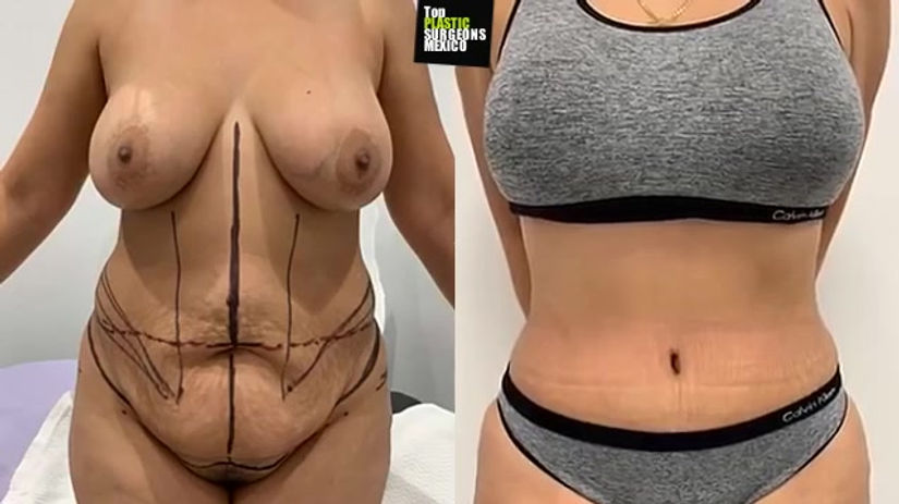 TUMMY TUCK + 360°LIPO